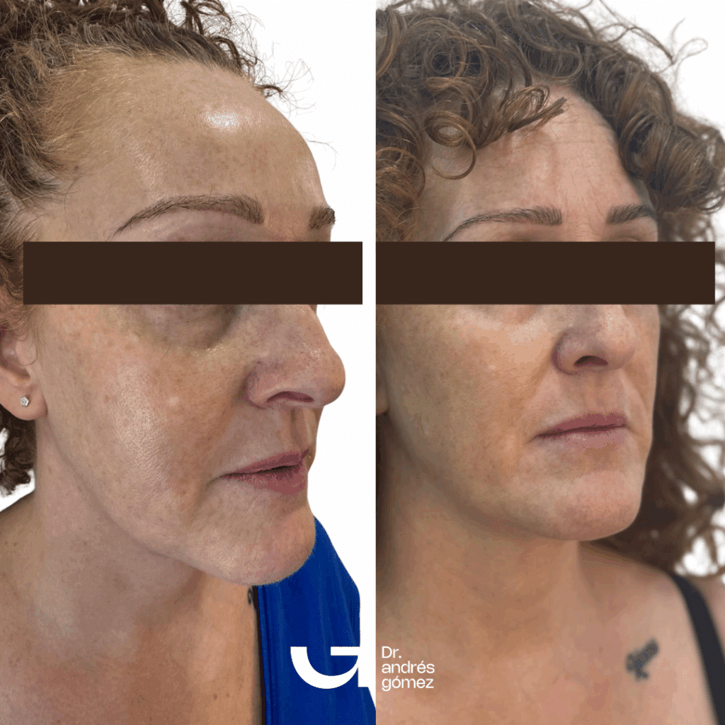 Antes y Después Bioestimuladores de Colágeno