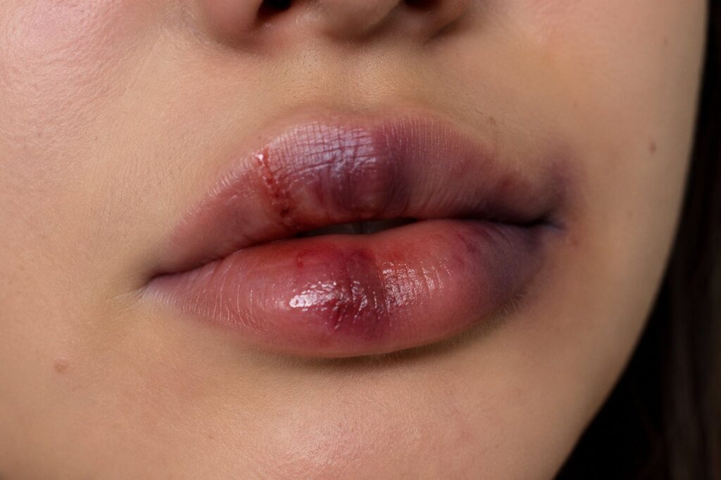 Hematoma visible en labios tras tratamiento con ácido hialurónico, mostrando moratones y suturas.