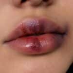 Hematoma visible en labios tras tratamiento con ácido hialurónico, mostrando moratones y suturas.