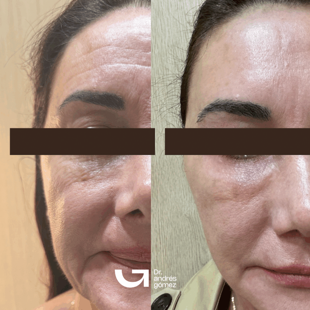 Antes y Después Bioestimuladores de Colágeno: Sculptra