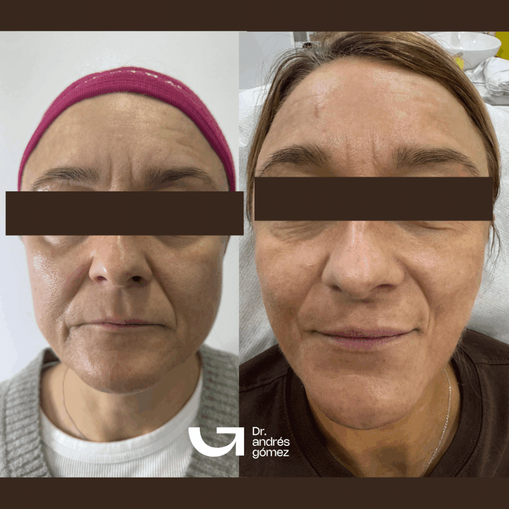 Antes y Después Bioestimuladores de Colágeno: Radiesse