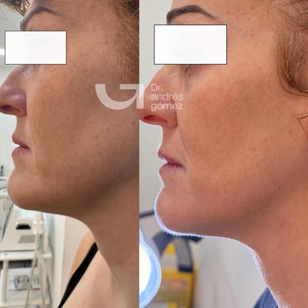 FOTO ANTES Y DESPUÉS ENDOLIFTING FACIAL