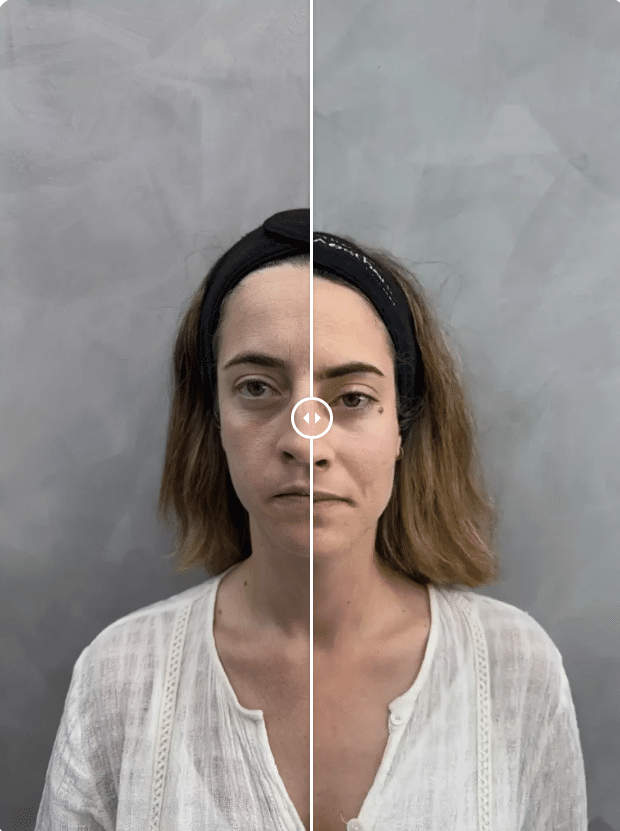 Antes y Después Armonización Facial