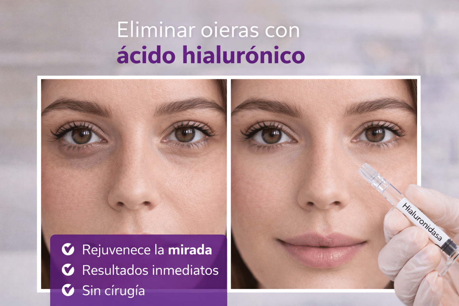 Eliminar ojeras con ácido hialurónico: rejuvenece tu mirada sin cirugía