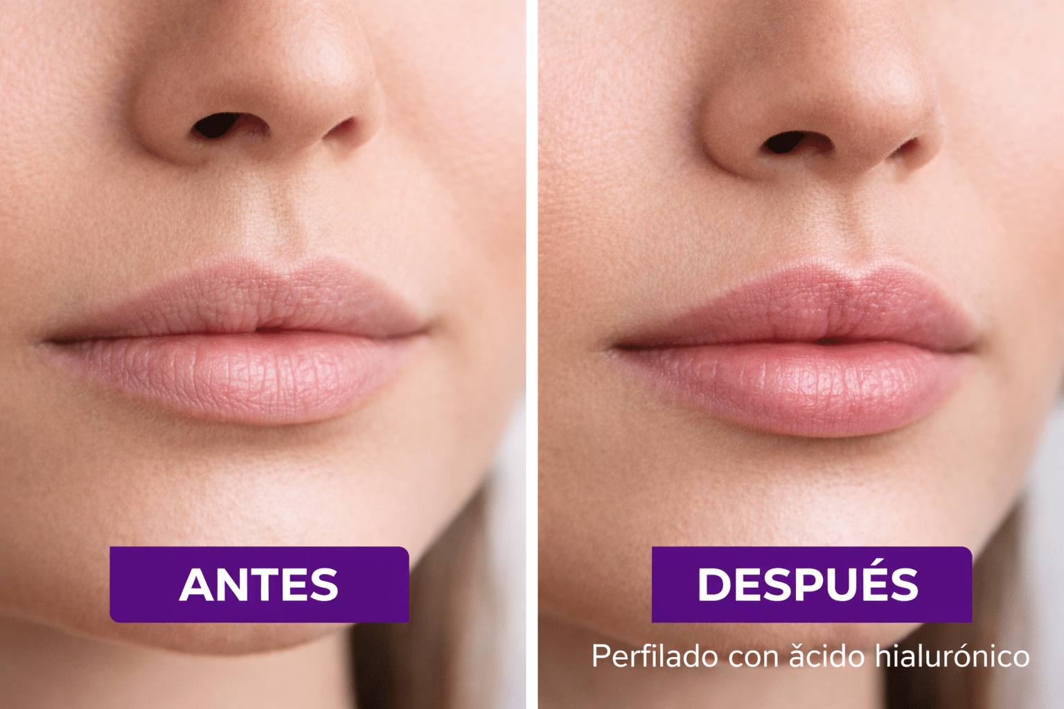 Perfilado de labios con ácido hialurónico: definición y naturalidad sin exceso de volumen