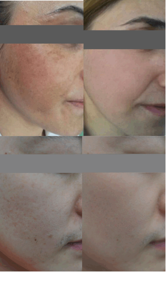 Antes y Después Láser de Co2