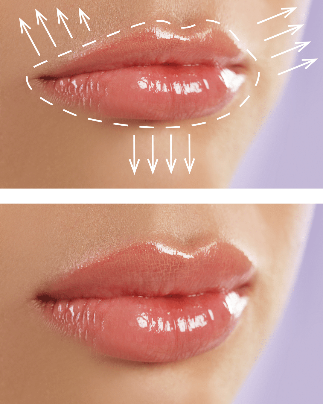 Aumento de labios en Madrid: ¡Consigue los Labios que Deseas en 1 Sesión!