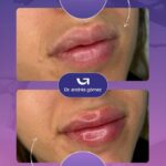 Cuánto tarda en bajar la inflamación de los labios después del ácido hialurónico