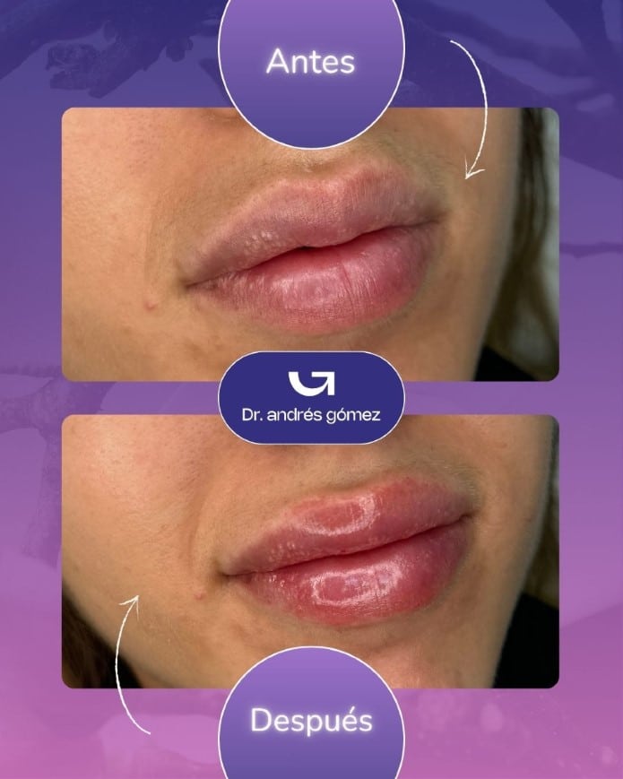 Cuánto tarda en bajar la inflamación de los labios después del ácido hialurónico