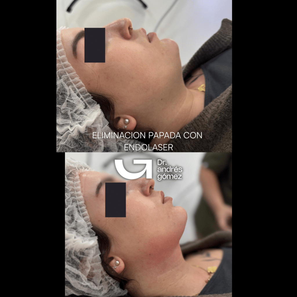 FOTO ANTES Y DESPUES ENDOLITING DE PAPADA