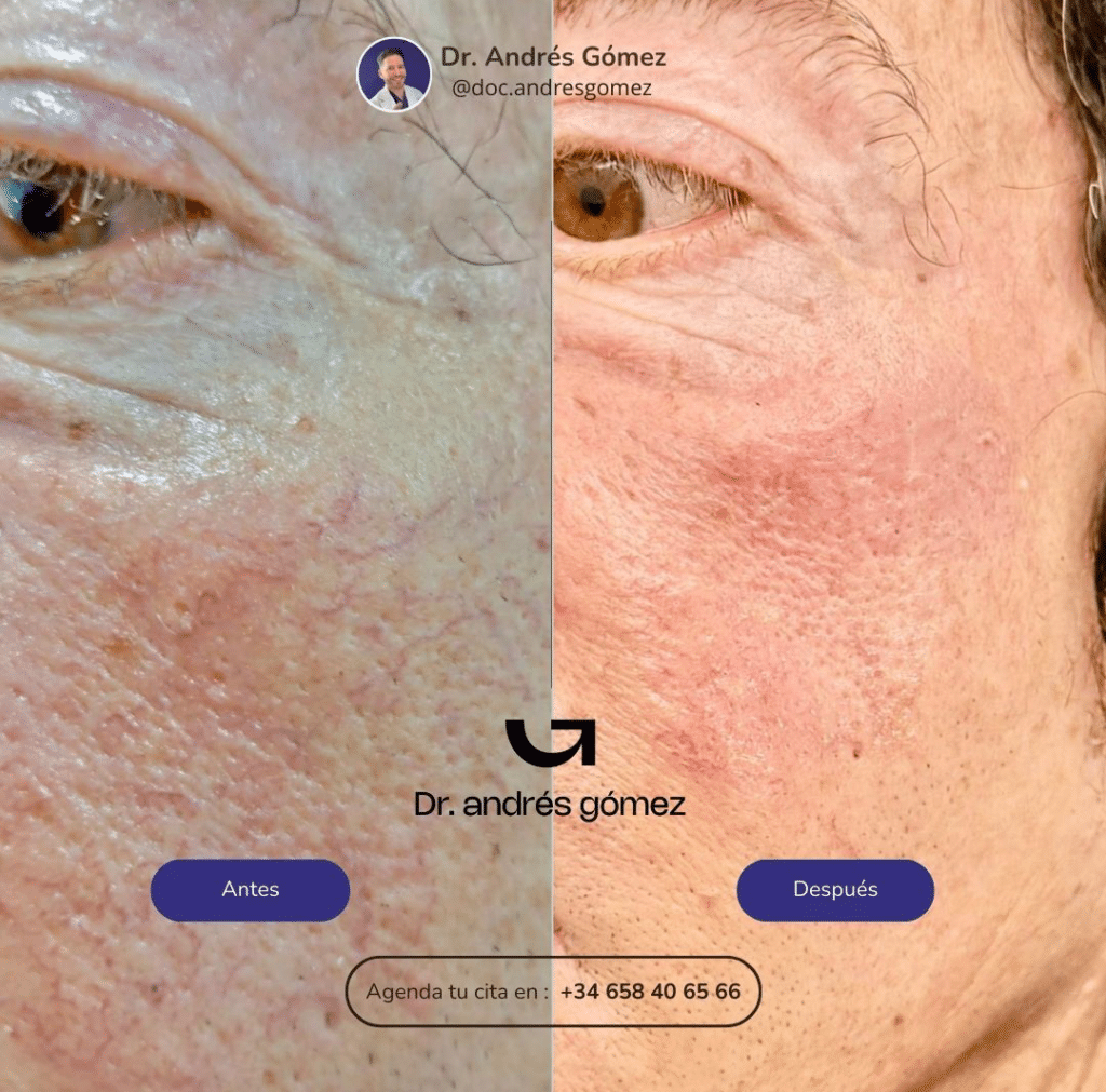 Eliminación de Arañas Vasculares en Madrid Antes y Después