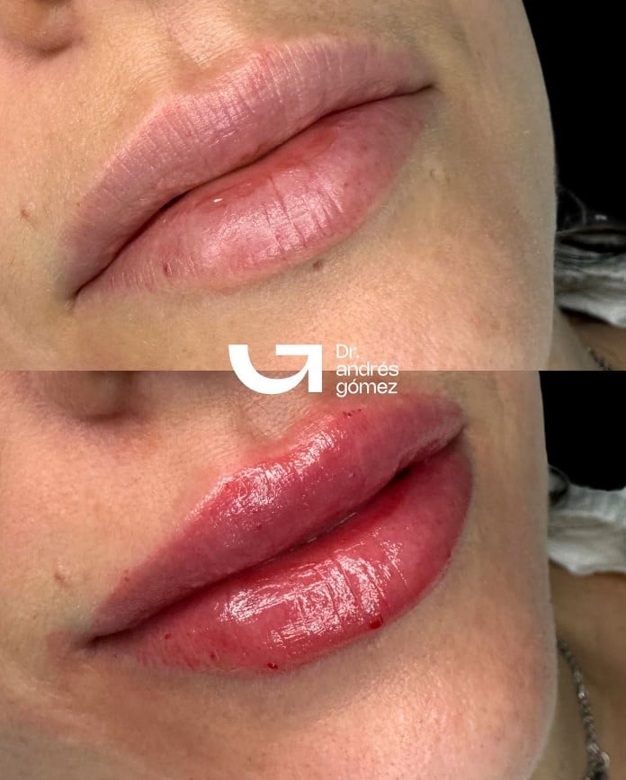Labios deformados por ácido hialurónico: Causas y cómo solucionarlo