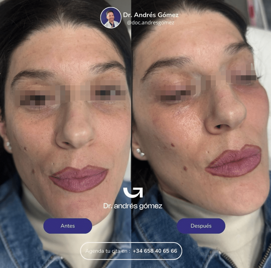 Polinucleotidos Madrid Antes y Depués