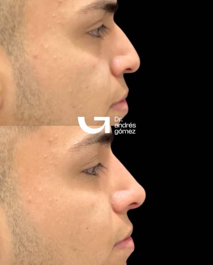 Rinomodelación con ácido hialurónico en Madrid