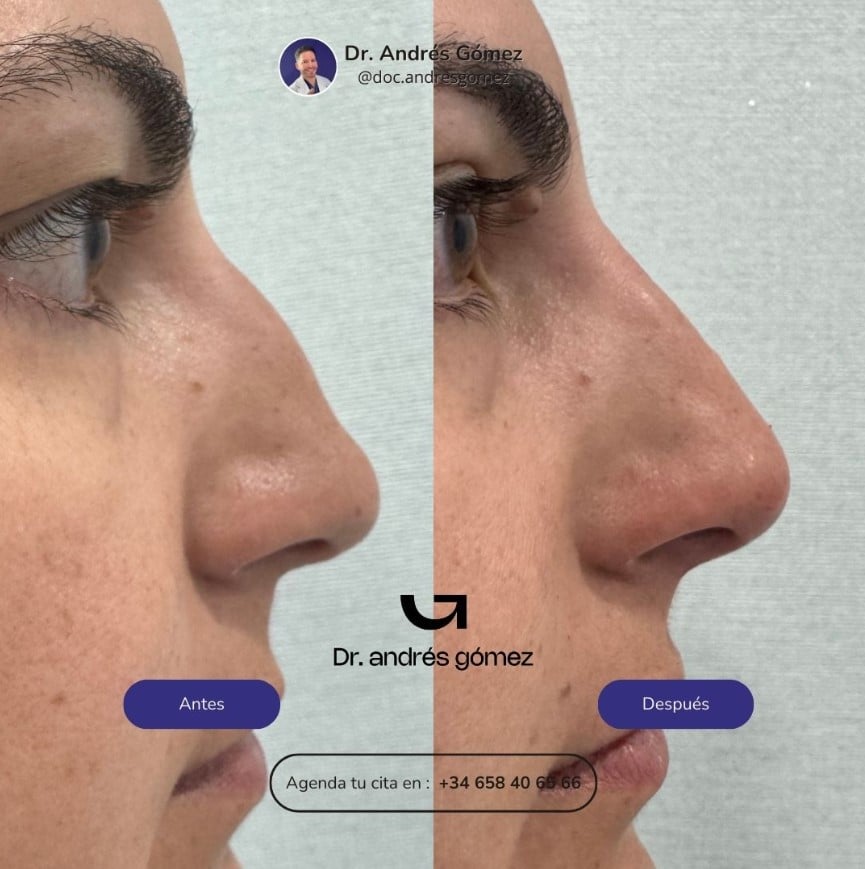 Rinomodelación con Ácido Hialurónico en Madrid