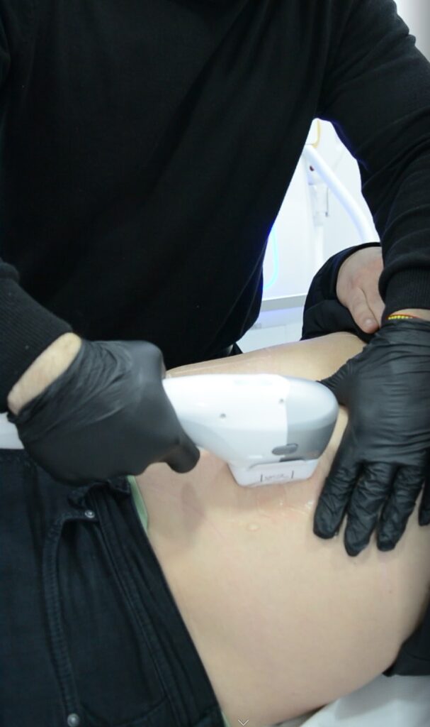 Eliminar grasa abdominal hombres en Madrid