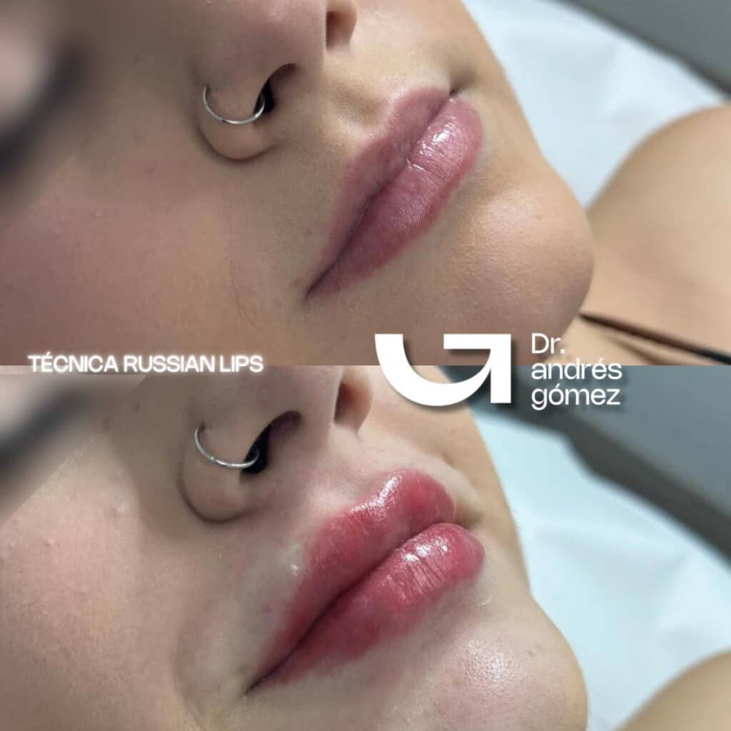 Russian Lips En MAdrid