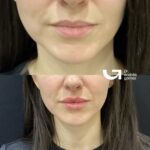 Hidratación de labios con ácido hialurónico: Todo lo que debes saber