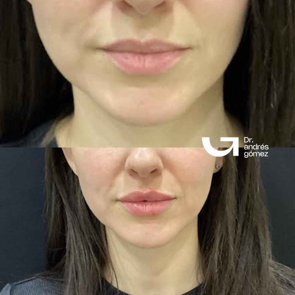 Russian Lips Antes y Después