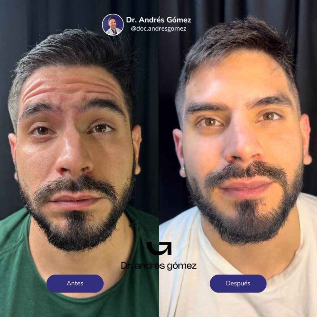 Tratamiento Antiarrugas Hombre Madrid