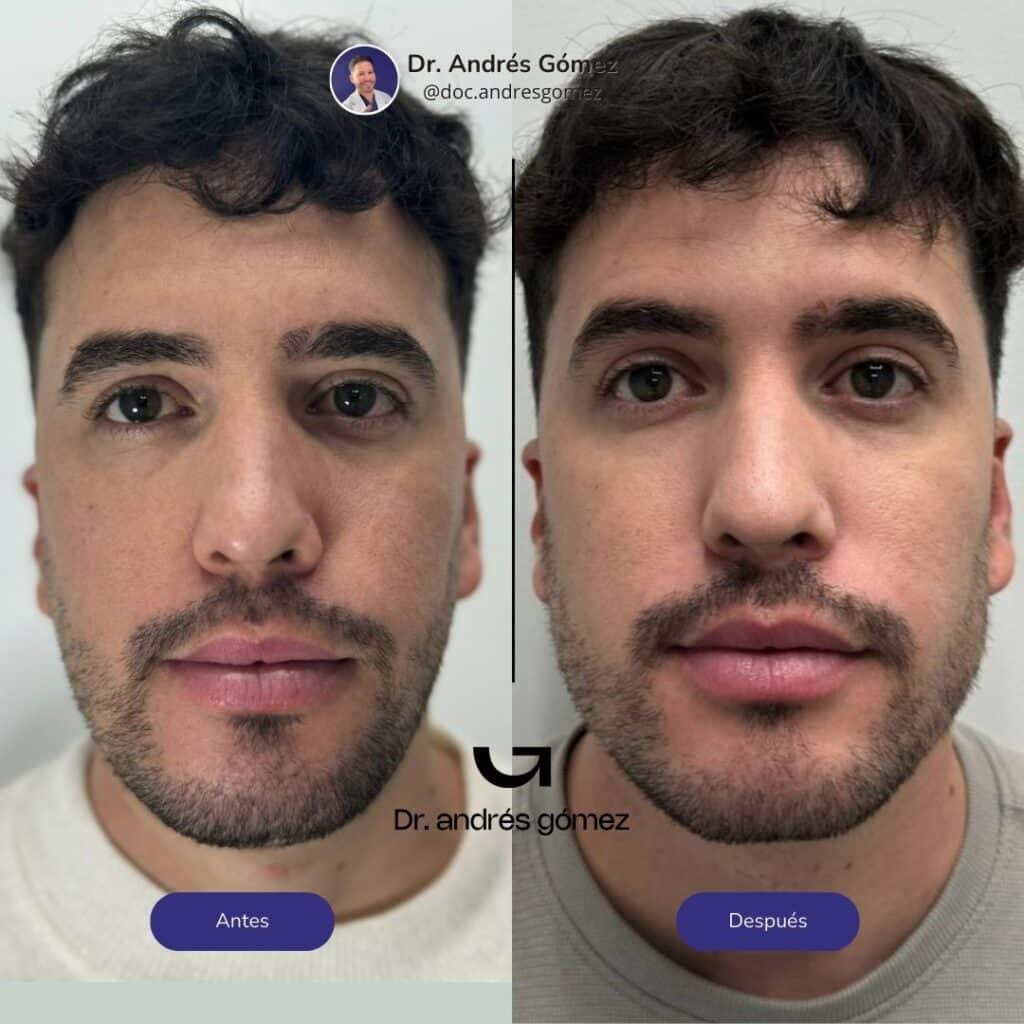 Masculinización Facial en Madrid para Hombres