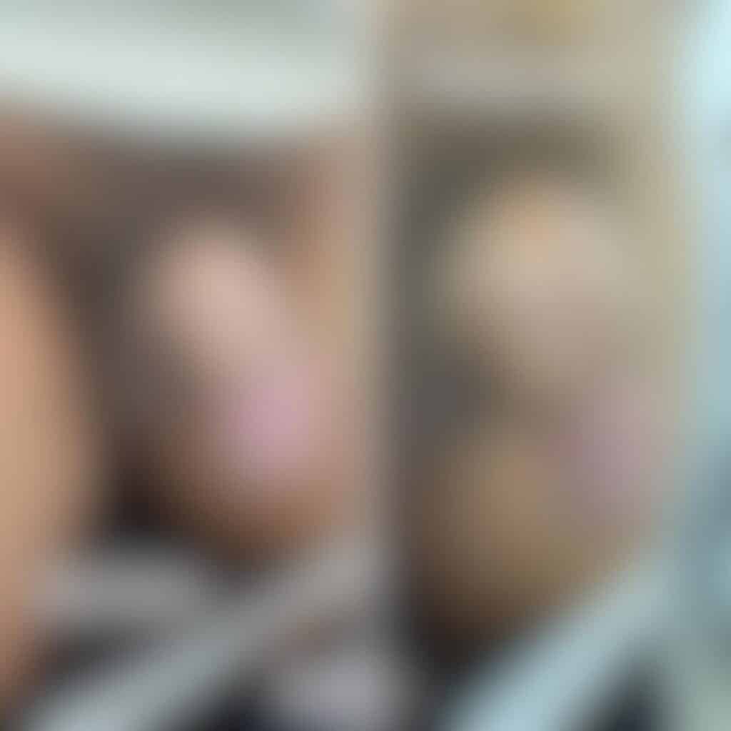 Engrosamiento peneano en Madrid con Ácido Hialurónico