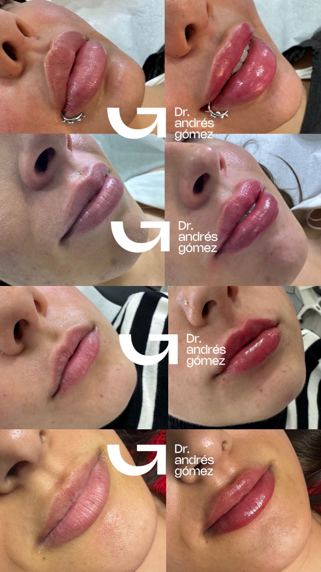 Aumento de labios