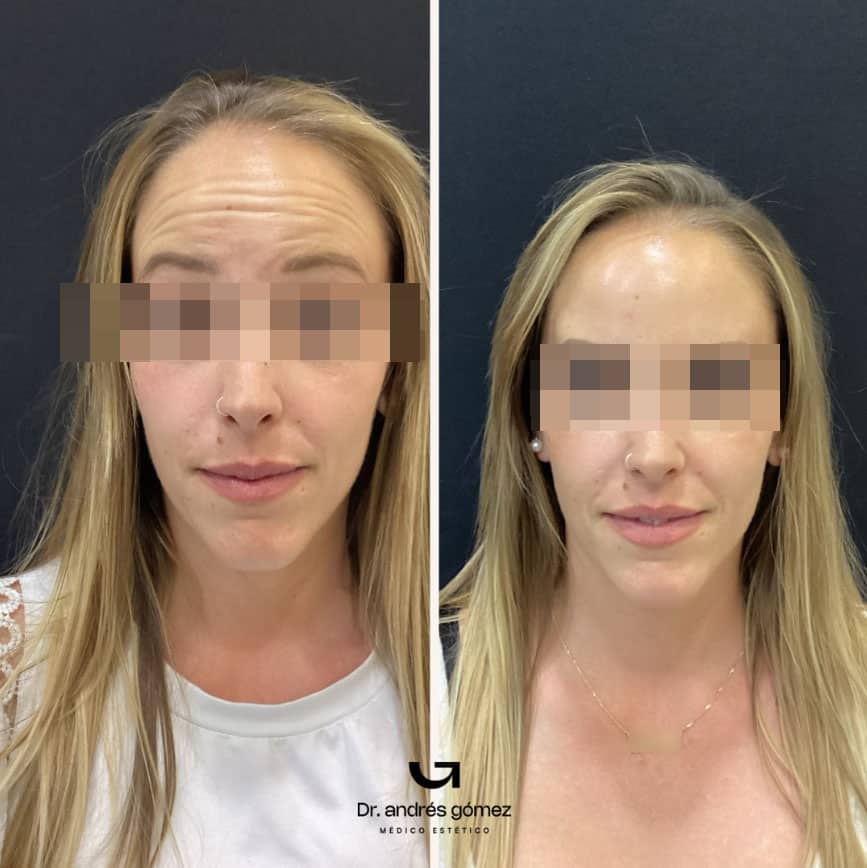 Médico aplicando Botox para suavizar arrugas de expresión y rejuvenecimiento facial