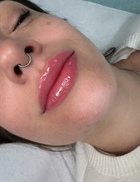 Resultado en consulta de aumento de labios, caso 1. Fotografía completa facilitada para la web.