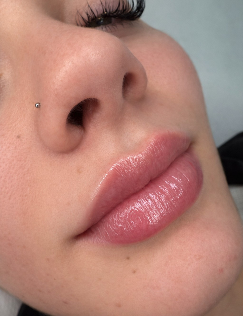 Resultado en consulta de aumento de labios, caso 2. Fotografía completa facilitada para la web.