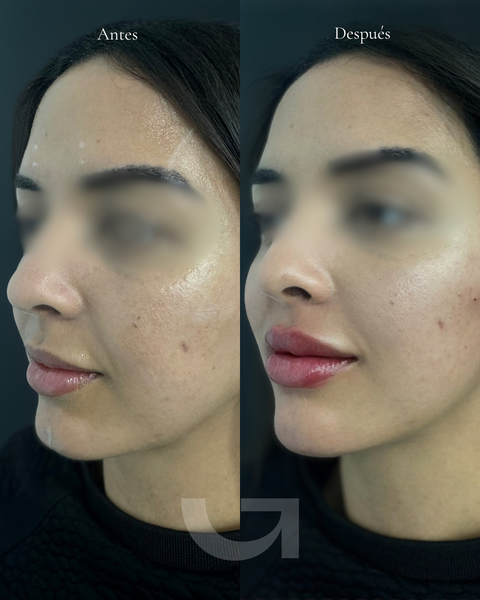 Antes y después de armonización facial, caso 1. Fotografía completa facilitada para la web.