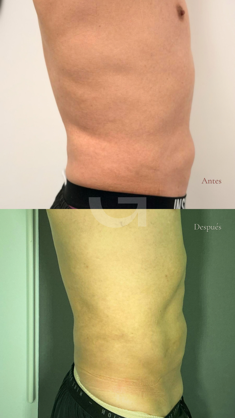 Antes y después de endolifting corporal, caso 1. Fotografía completa facilitada para la web.