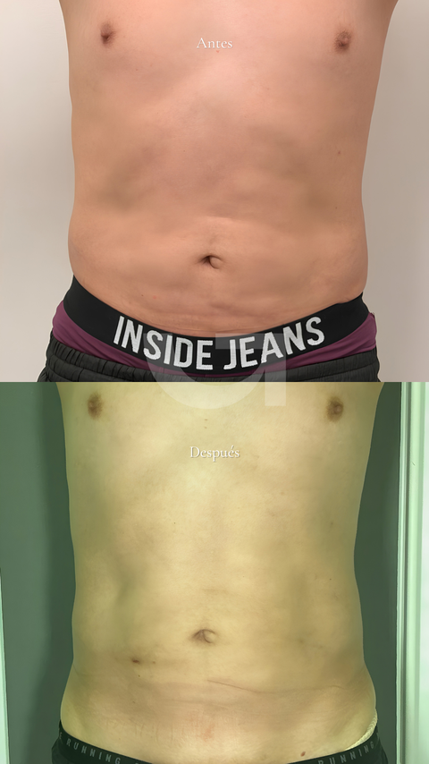 Antes y después de endolifting corporal, caso 2. Fotografía completa facilitada para la web.