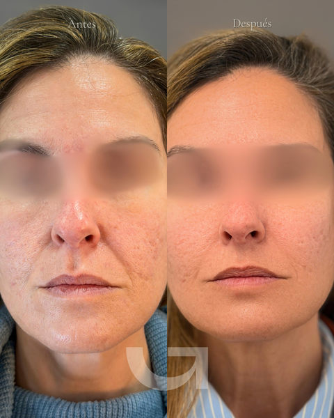 Antes y después de endolifting facial y papada, caso 1. Fotografía completa facilitada para la web.