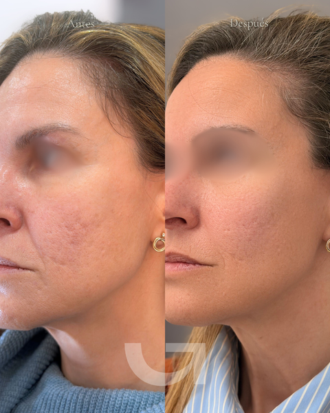 Antes y después de endolifting facial y papada, caso 2. Fotografía completa facilitada para la web.