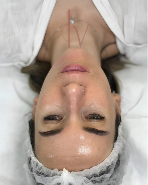 Resultado en consulta de limpiezas faciales holiskin, caso 3. Fotografía completa facilitada para la web.