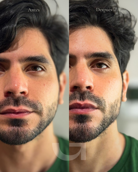 Antes y después de mandíbula definida para hombres, caso 1. Fotografía completa facilitada para la web.
