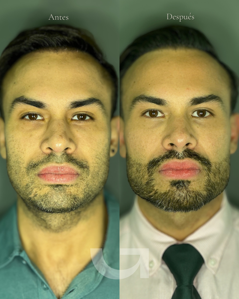 Antes y después de mandíbula definida para hombres, caso 2. Fotografía completa facilitada para la web.