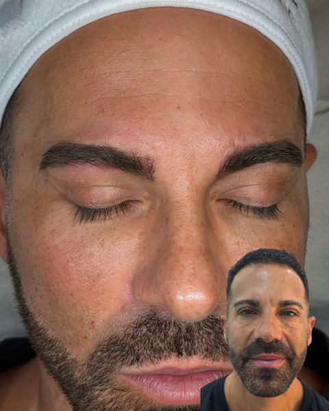 Resultado en consulta de micropigmentación de cejas y labios, caso 3. Fotografía completa facilitada para la web.