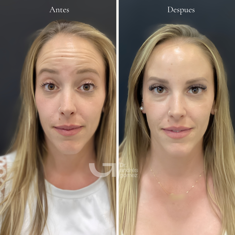 Antes y después de neuromoduladores, caso 1. Fotografía completa facilitada para la web.