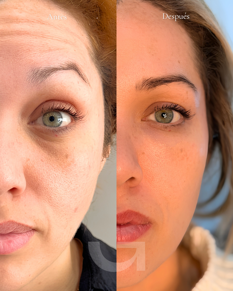 Antes y después de ojeras, caso 1. Fotografía completa facilitada para la web.