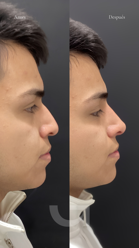 Antes y después de rinomodelación, caso 1. Fotografía completa facilitada para la web.