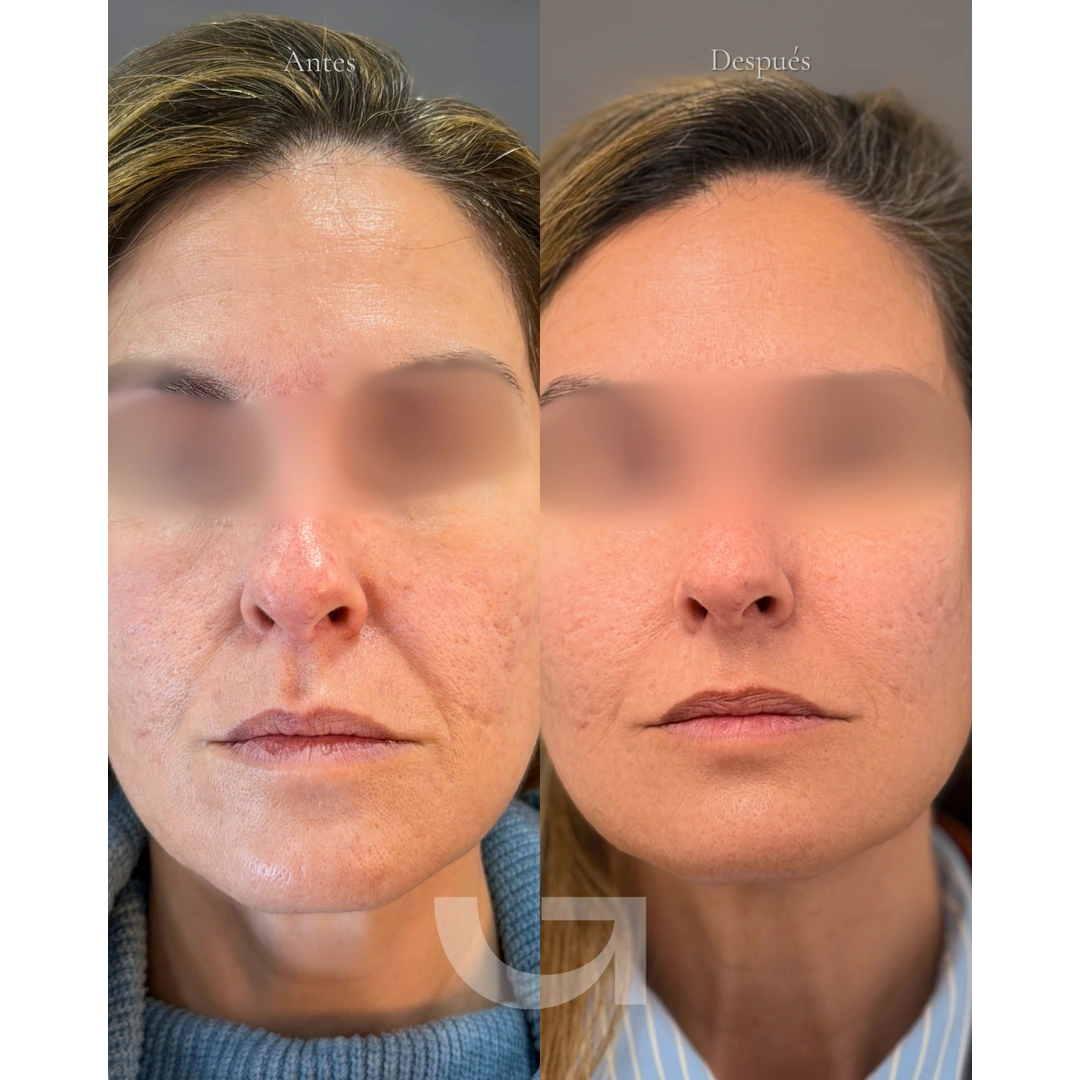 Caso clínico 01: comparativa frontal de antes y después, con los ojos difuminados