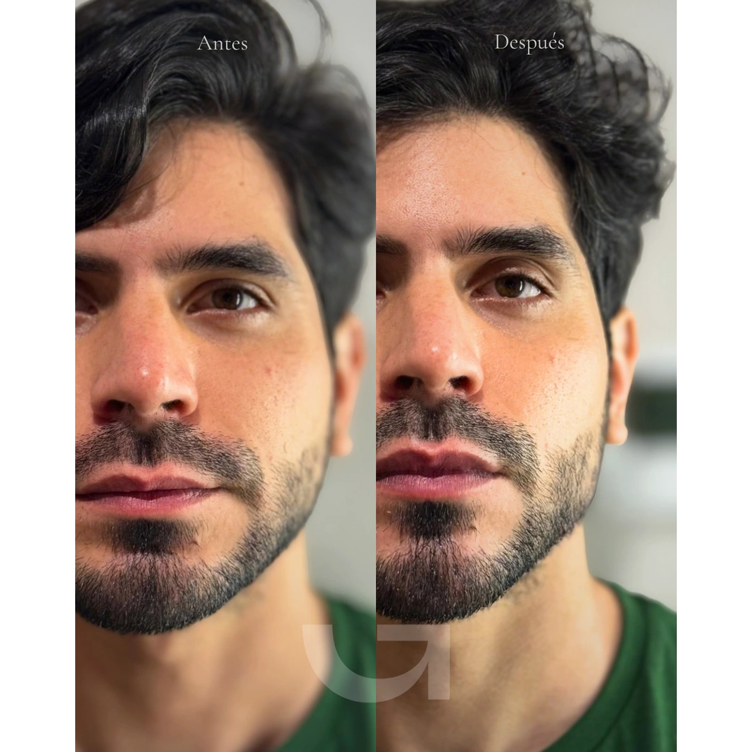 Caso clínico 02: comparativa facial masculina de antes y después
