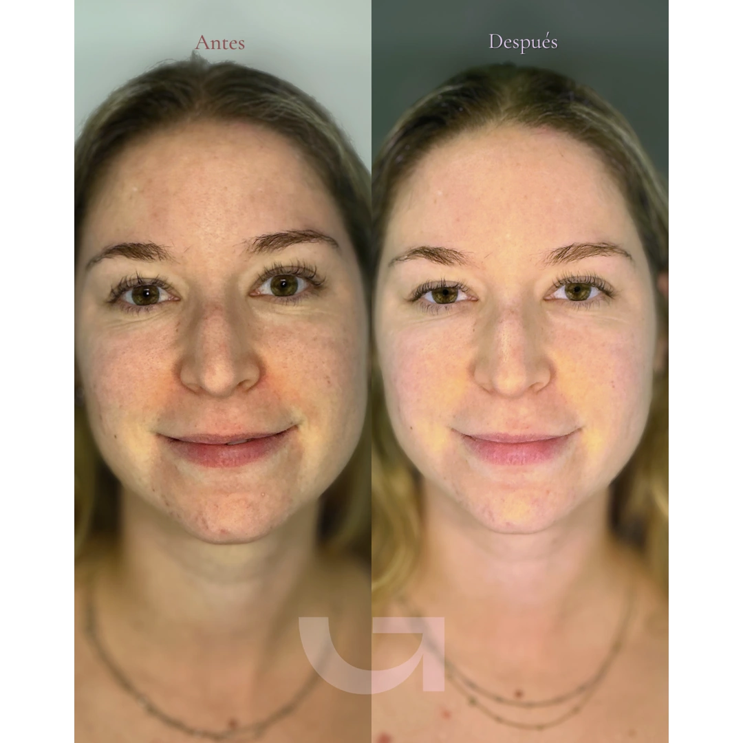 Caso clínico 03: comparativa facial de antes y después