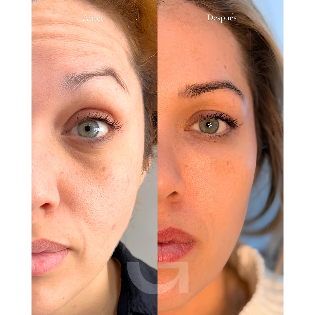 Caso clínico 04: comparativa de la zona de la mirada antes y después