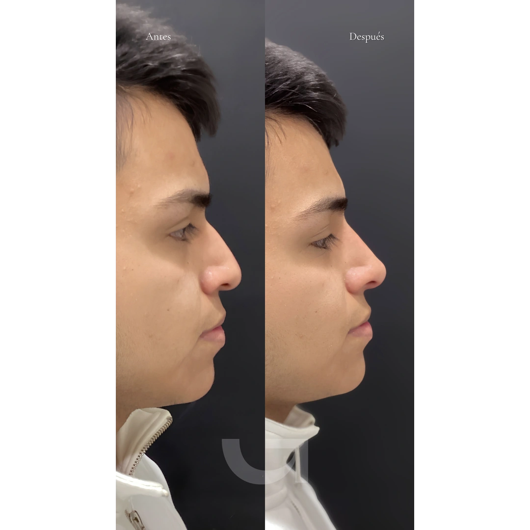 Caso clínico 06: comparativa del perfil facial antes y después
