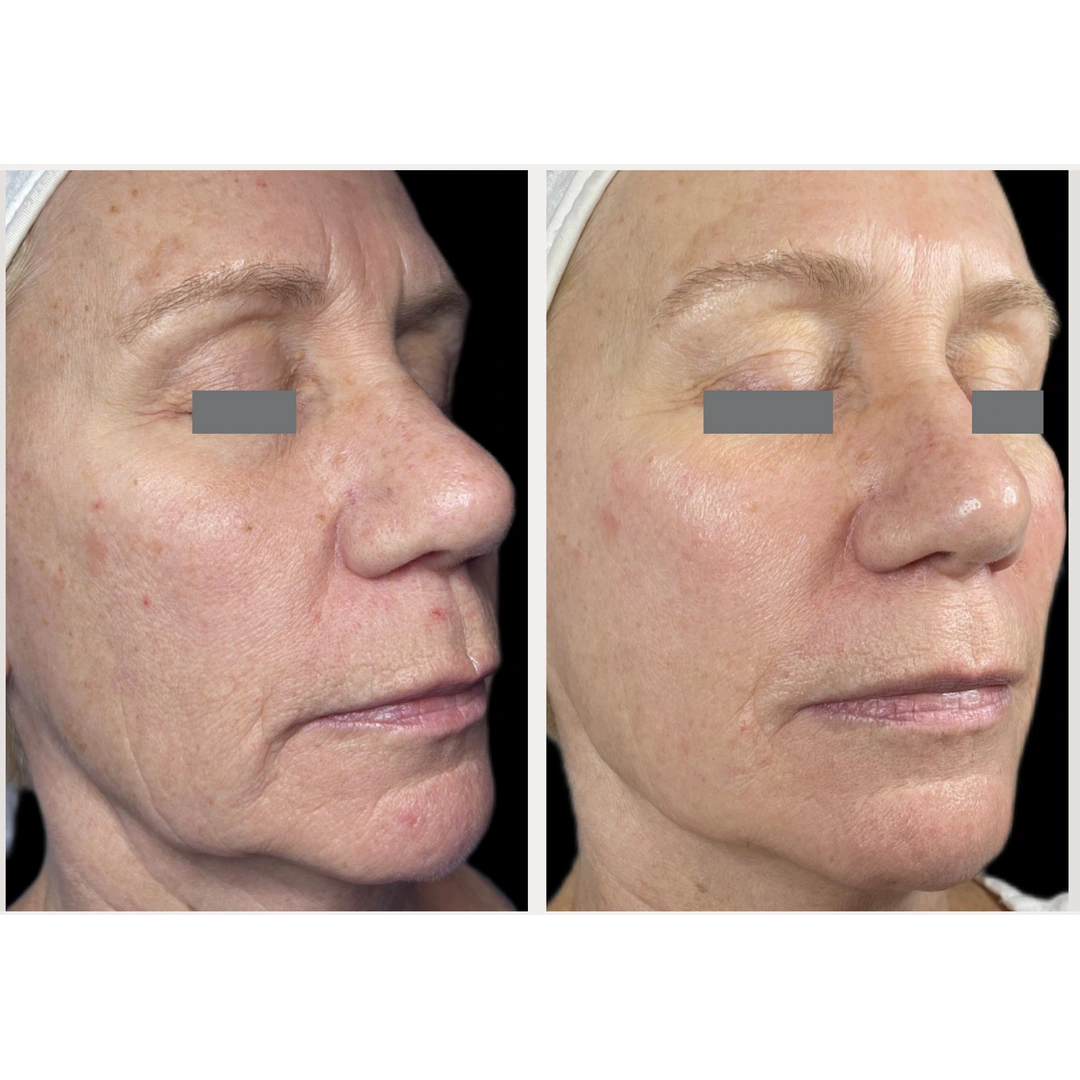 Caso clínico 07: comparativa facial lateral de antes y después, con los ojos ocultos