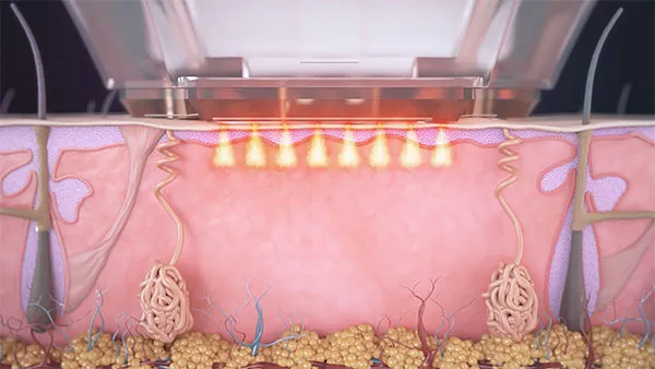 Esquema de Sublative: una matriz de electrodos administra radiofrecuencia fraccionada desde la superficie cutánea