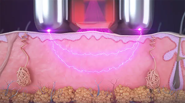 Esquema de Sublime: combinación de luz infrarroja y radiofrecuencia para calentar el tejido dérmico